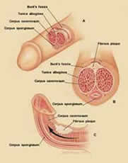 Spiral-shaped calluses on the penis